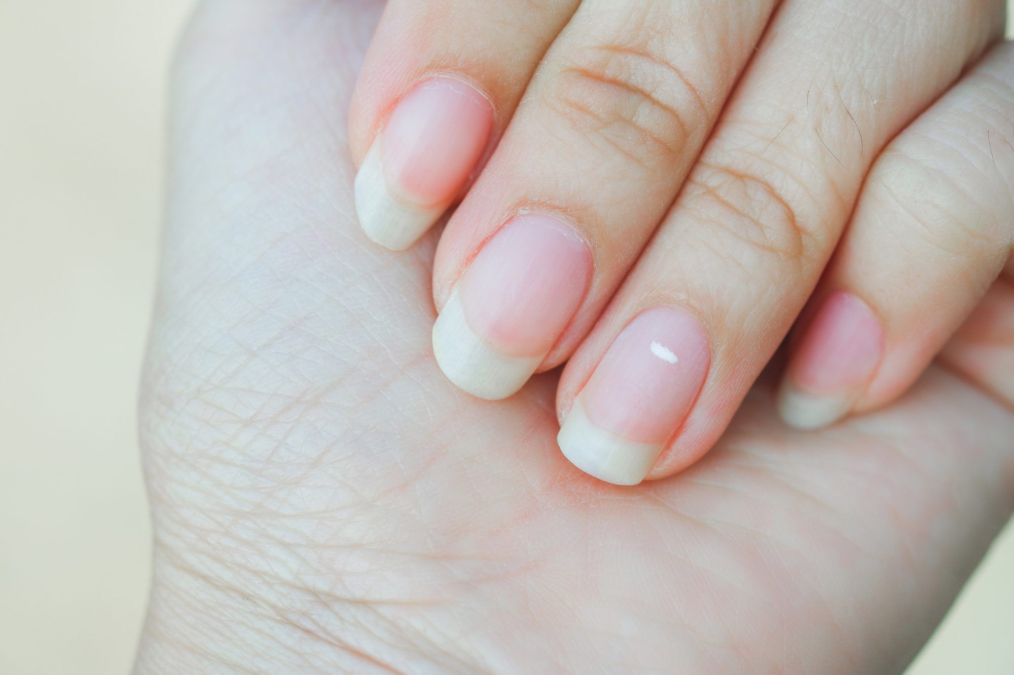Warum Sie weiße Flecken auf Ihren Nägeln bekommen – und wie Sie sie loswerden